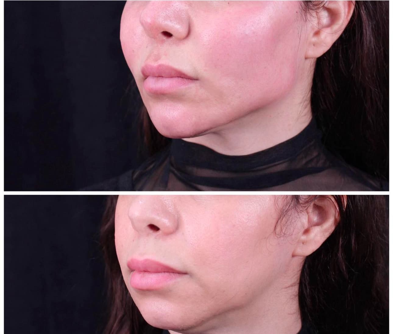 Före Rynkbehandling