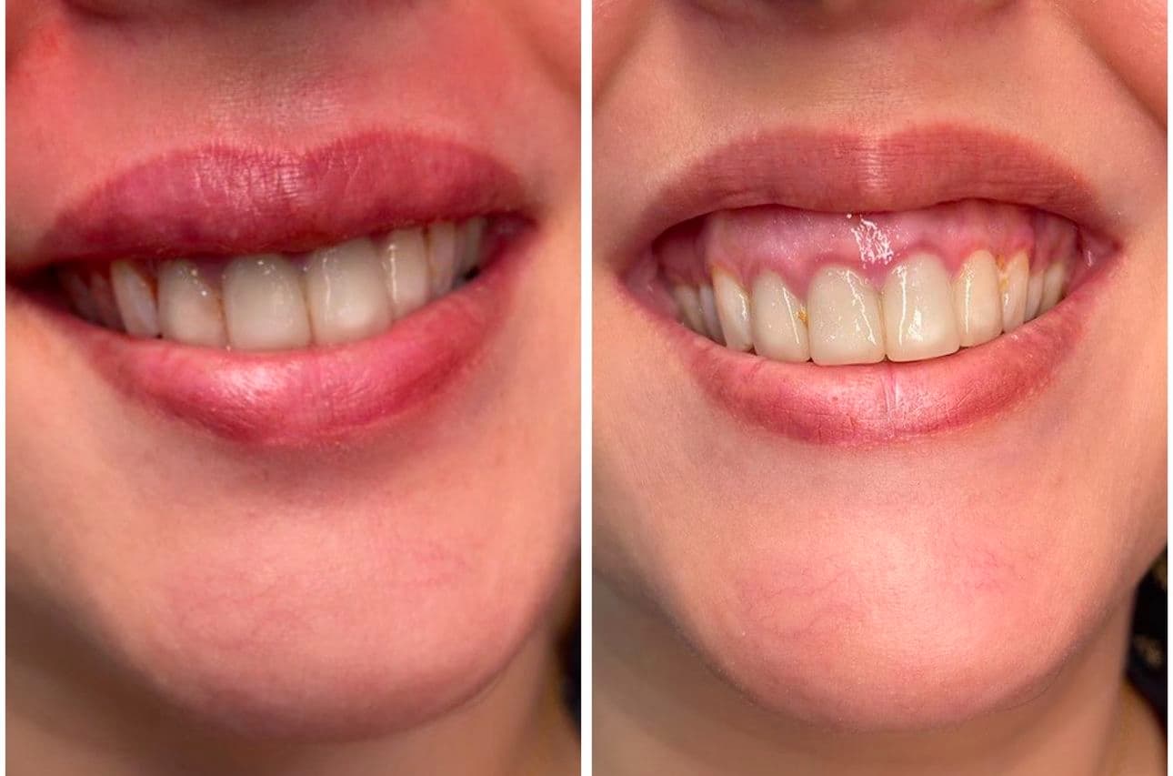 Efter Rynkbehandling