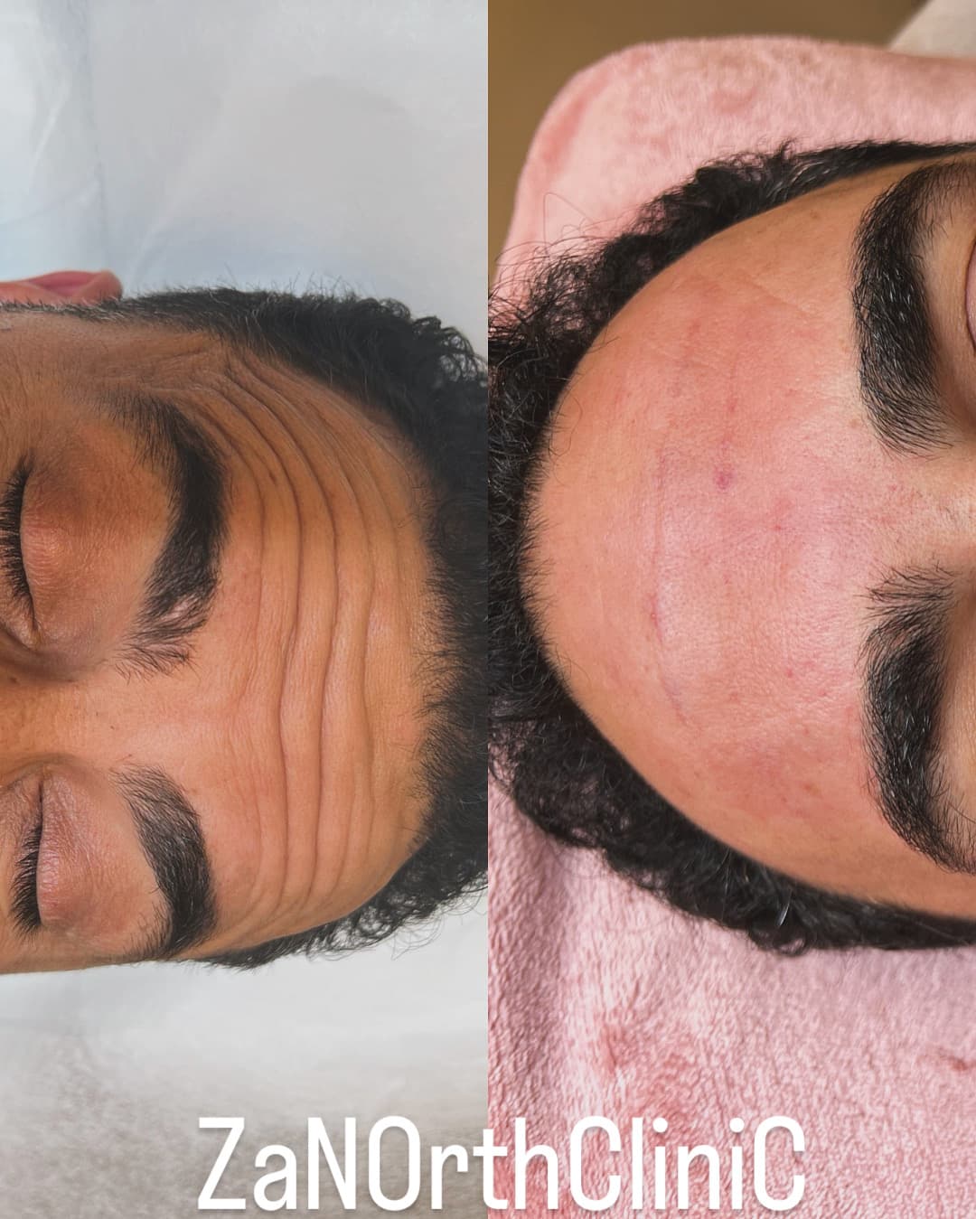 Efter Nasolabialaveck