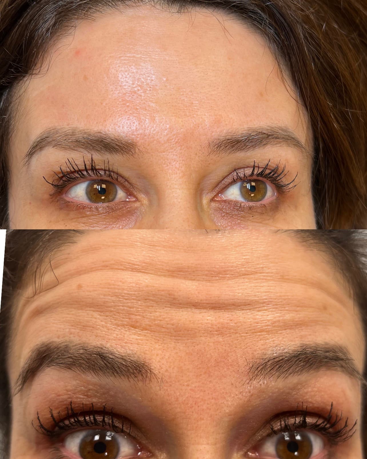 Före Laserhårborttagning